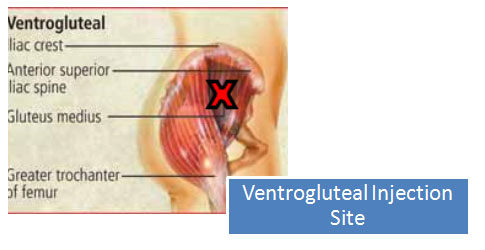 Leg injection sites for steroids