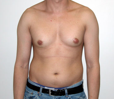 Gynaecomastia