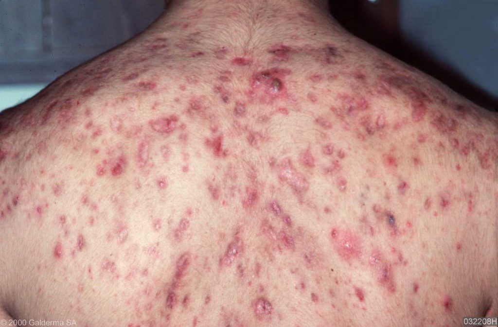 Steroids For Acne Side Effects at Cynthia Williams blog