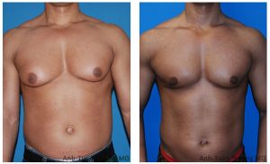 Gynecomastia steroids treatment