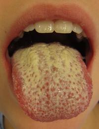 tongue yellow infection